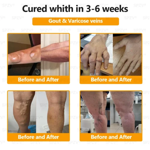 𝐒𝐩𝐳𝐯® 𝐁𝐞𝐞 𝐕𝐞𝐧𝐨𝐦 𝐏𝐚𝐢𝐧-𝐑𝐞𝐥𝐢𝐞𝐟 𝐁𝐨𝐧𝐞 𝐇𝐞𝐚𝐥𝐢𝐧𝐠 𝐂𝐫𝐞𝐚𝐦