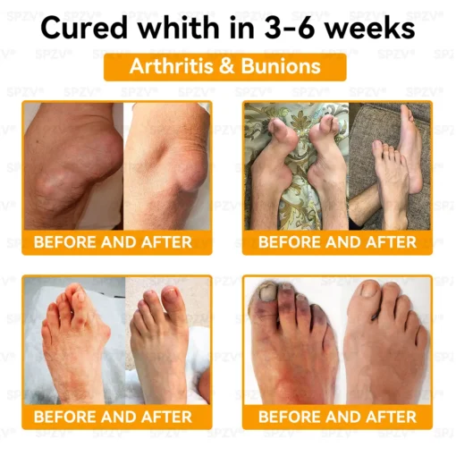 𝐒𝐩𝐳𝐯® 𝐁𝐞𝐞 𝐕𝐞𝐧𝐨𝐦 𝐏𝐚𝐢𝐧-𝐑𝐞𝐥𝐢𝐞𝐟 𝐁𝐨𝐧𝐞 𝐇𝐞𝐚𝐥𝐢𝐧𝐠 𝐂𝐫𝐞𝐚𝐦
