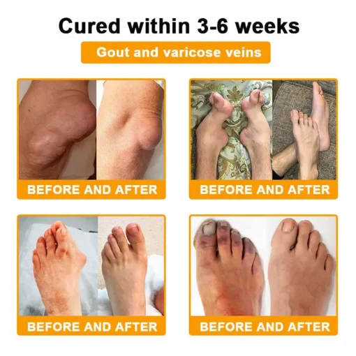 Spzv® Botulinum Toxin & Bee Venom Pain-Relief Bone Healing Cream