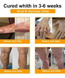 Spzv® Botulinum Toxin & Bee Venom Pain-Relief Bone Healing Cream