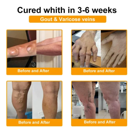 Spzv® Botulinum Toxin & Bee Venom Pain-Relief Bone Healing Cream