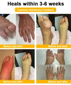 Spzv® Botulinum Toxin & Bee Venom Pain-Relief Bone Healing Cream