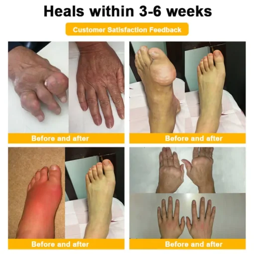 Spzv® Botulinum Toxin & Bee Venom Pain-Relief Bone Healing Cream