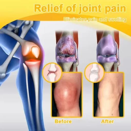 Spzv® Botulinum Toxin & Bee Venom Pain-Relief Bone Healing Cream